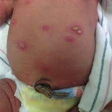 Rashes can appear on your baby's face, back, or another body part. Visual Diagnosis A Neonate With Rash And Fever American Academy Of Pediatrics