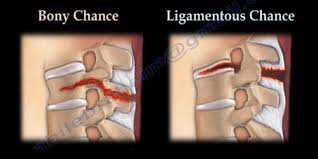 Image result for Chance Fracture