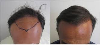 Fue hair transplant in los angeles has surpassed other hair loss treatment options offered. Hair Transplant Los Angeles Cost Cost Of Hair Restoration In Los Angeles