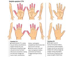 Video ini membincangkan punca kebas tangan yang kerap terjadi dan cara rawat kebas dengan cepat dan. Apa Itu Carpal Tunnel Syndrome Apa Penyebabnya Cara Mengobatinya Berita Teknologi Terbaru