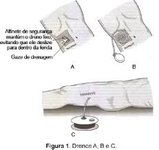 Para impedir o acúmulo de líquidos, evitar infecção e ajudar na cicatrização. Q700167 Questoes De Concursos Qconcursos Com
