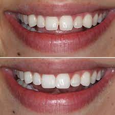 In most cases, this is not a recommended missing tooth replacement option. Cosmetic Dental Bonding Orlando Dynamic Smile Design