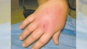 Image result for Septic Joint