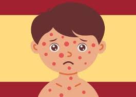 Image result for measles