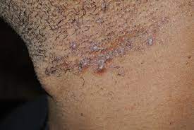 Pictures, treating vaginal ingrown bumps there are so many reasons why you want to keep your groin area clean and free of sore bumps. Ingrown Hairs Pretty Faces Atlanta