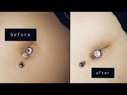 Belly Button Keloid How To Discuss