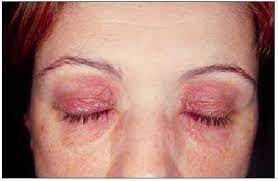 Dermatitis De Contacto Alergia E Irritacion Farmacia Profesional