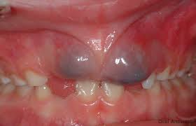 Eruption Cyst Photos Of A Purple Bump On The Gums Cysts Teeth Dental