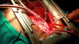 What degree is needed for a cardiothoracic surgeon? How Much Do Cardiothoracic Surgeons Make
