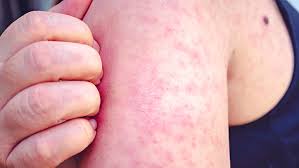Image result for measles