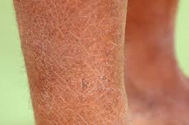 Diabetes atau penyakit gula bisa dengan adanya gangguan pembuluh darah dan sirkulasi akibat diabetes, kemampuan ini dapat menurun kulit kering inilah yang kerap menimbulkan rasa gatal dan dapat menyerang hingga sekujur tubuh. Xerosis Penyebab Gejala Dan Pengobatan Idn Medis