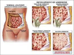Pin On Adhesion Related Disorder