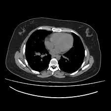 Polat fr, polat s, sultanoglu e. Hepatic Hydatid Cyst Intrathoracic Rupture Radiology Case Radiopaedia Org