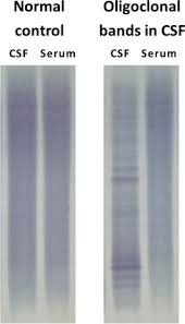 Image result for Cerebrospinal Fluid Color