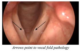 A hoarse voice may be a barely noticeable change in the volume of your speech or it may be pronounced, with a raspy sound that is hardly audible. Vocal Nodules Hoarse Voice In Singers