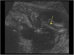 아두이노 초음파 거리측정기 (i2c lcd 사용). Abdomen And Retroperitoneum 1 5 Appendix Case 1 5 6 Post Appendectomy Ultrasound Cases