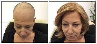 Different classes of chemotherapy drugs typically lead to varying not all chemotherapy will cause hair loss, but certain drugs will cause loss in varying degrees. Hair Loss Due To Chemotherapy Hairhotel