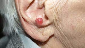 Adjuvant radiation therapy improves patient survival in early stage merkel cell carcinoma: What Is Merkel Cell Carcinoma Symptoms Causes Diagnosis Treatment And Prevention Everyday Health