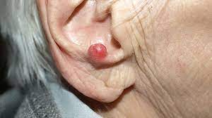 Watch for new spots or areas that are changing. What Is Merkel Cell Carcinoma Symptoms Causes Diagnosis Treatment And Prevention Everyday Health