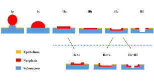 Please call your doctor's office or an urgent care clinic for advice about where you should go for treatment. Endoscopy Campus Paris Classification Early Colorectal Cancers