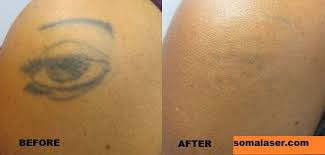 Also known as laser tattoo removal and body art removal. Laser Tattoo Removal In New Jersey Soma Skin Laser