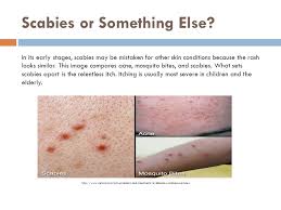 Within four weeks, your skin should heal. What Is Scabies Scabies Is Not An Infection But An Infestation Tiny Mites Called Sarcoptes Scabiei Set Up Shop In The Outer Layers Of Human Skin The Ppt Video Online Download
