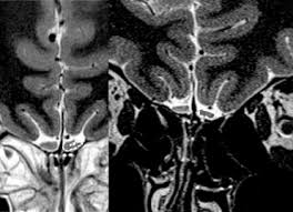 A clue to the olfactory code. Olfactory Bulb Mri And Paranasal Sinus Ct Findings In Persistent Covid 19 Anosmia Academic Radiology