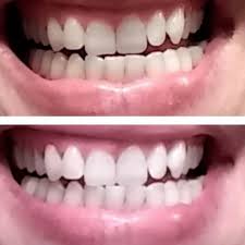 This means maintain a balanced diet of fruits cheese is one of the best foods for healthy teeth for a number of reasons. A Purple Shampoo For Teeth See The Shocking Befores Afters Behindthechair Com