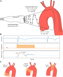 Frontiers | Methods: Aortic wall deformation assessment by ultrafast  ultrasound imaging: Application to bicuspid aortic valve associated  aortopathy
