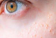 как вывести черные точки на носу в домашних условиях Izbavitsya Ot Belyh Tochek Na Lice Mozhno Ochen Prosto Vot 5 Samyh Effektivnyh Naturalnyh Receptov Jemchyjinka Ru Beauty Skin Care Skin Care Skin Problems