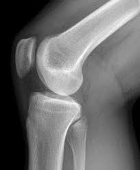 Articulations douloureuses, douleur au genou et arthrose du. Douleur Au Genou Clinique Kine Sante