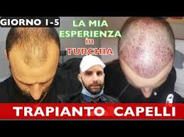 Il trapianto di capelli in turchia raccontato dal nostro paziente italiano. Trapianto Di Capelli In Turchia Le Migliori 10 Cliniche Nel 2022