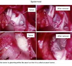Cranial Nerve Surgery Disease Epidermoid Tumor Treatment Of Disorder Tokushukai Group
