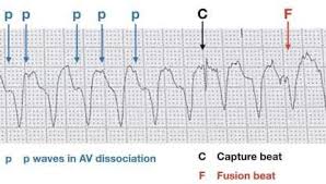 Vt Versus Svt Litfl Medical Blog Ecg Library Basics Ventricular Tachycardia Dissociation Ecg Interpretation