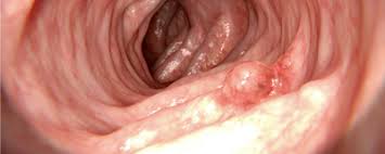 Although colon cancer (also referred to as colorectal cancer) can develop at any age in adults, it typically affects women and men who are age 50+, who have an increased risk of developing colon cancer. There S A Troubling Rise In Colorectal Cancer Among Young Adults The Scientist Magazine