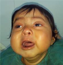 Infantile Wernicke's encephalopathy