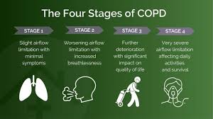 Image result for COPD Staging
