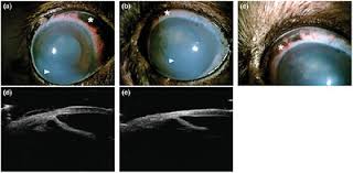 Image result for melanosis sclera