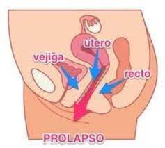 Prolapso De Vejiga Sintomas Causas Y Tratamiento
