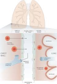Image result for Parapneumonic Effusion