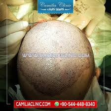 Get A Hair Transplant Plus Thickhair In Turkey Using Latest Technique In Camilia Hair Clinic Istanbul Hair Transplant Hairstyles Plastic Sur Body Fruit