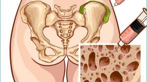 Stage iv bone cancer can be any tor n, meaning the tumor may be any size and may have grown into the lymph nodes. Finding The Best Donors For Bone Marrow Transplantation Onco Com