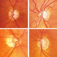 Examples Of Glaucomatous Optic Disc Features Download Scientific Diagram