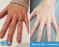 Back in early 2019 they contact our office tattoo removal. Laser Tattoo Removal Lincoln Laser Skin Care