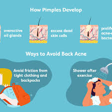 To treat sweat pimples, apply benzoyl peroxide, salicylic acid or retinol to the affected area to clean the pores and help prevent future breakouts. Body And Back Acne Basics Causes And Treatment