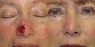 If breast cancer is diagnosed at an early enough stage, it's treatable. Nose Reconstruction Gallery Skin Cancer And Reconstructive Surgery Center