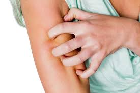 Putting calamine lotion or nonprescription hydrocortisone cream on the bite can help ease the itch. From Toothpaste To Aspirin The 10 Household Items To Ease Agony Of Mosquito Bites And Stings