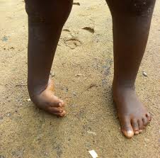 Clubfoot translated between english and german including synonyms, definitions, and related words. Liberia Clubfoot Program Home Facebook