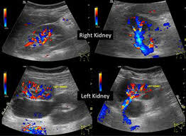 Duplication Of Ureter In A 7 Year Old A Case Report Abstract Europe Pmc
