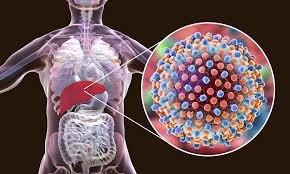 Hepatitis is inflammation of the liver tissue. Was Ist Hepatitis Bmbf